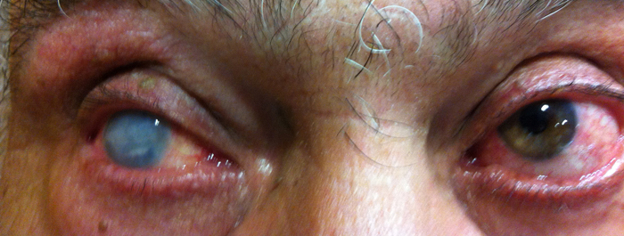 Paciente con córnea opaca en su ojo derecho